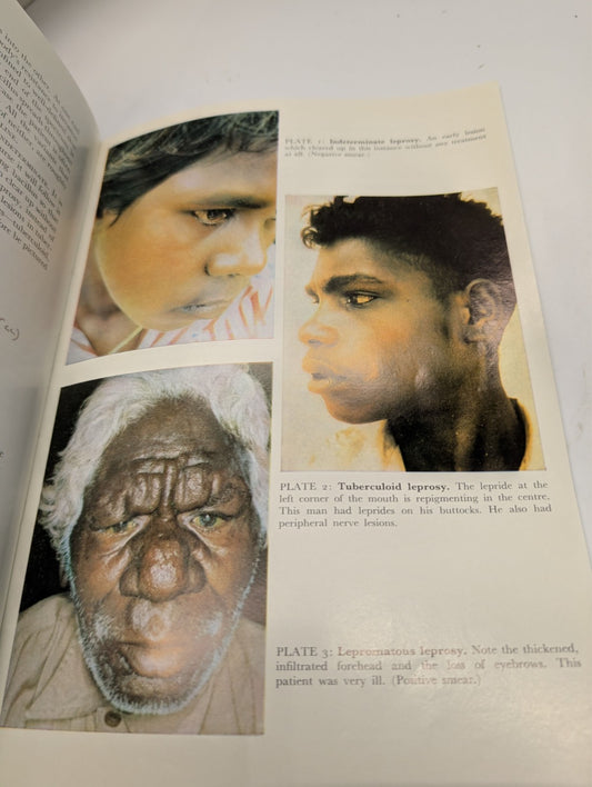 Leprosy in Northern Territory Aborigines 1970 work