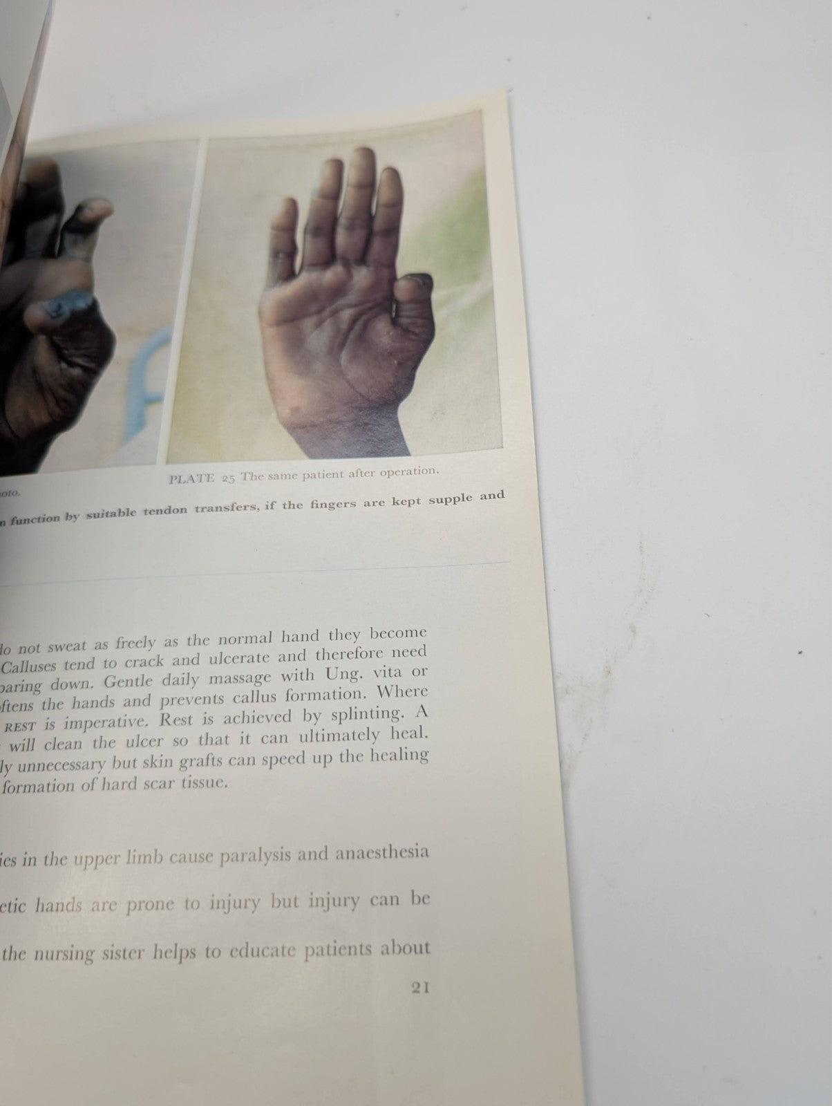 Leprosy in Northern Territory Aborigines 1970 work